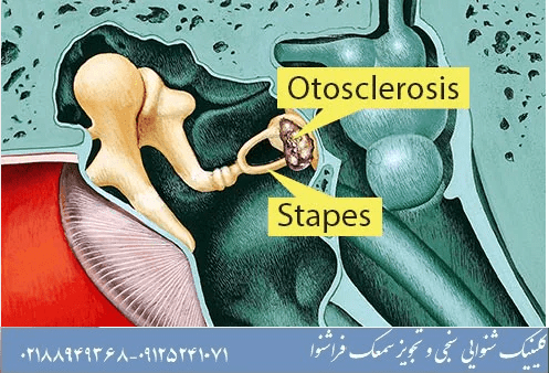 بیماری اتواسکلروزیس
