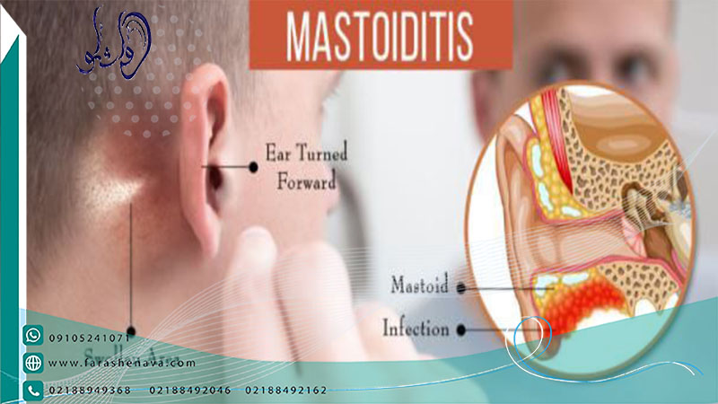 ماستوئیدیت بیماری های گوش میانی و داخلی