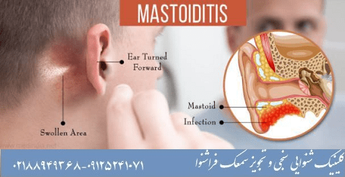 ماستوئیدیت: بیماری های گوش میانی و داخلی