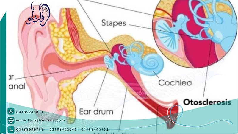 بیماری اتواسکلروزیس گوش میانی باعث وزوز گوش می شود؟