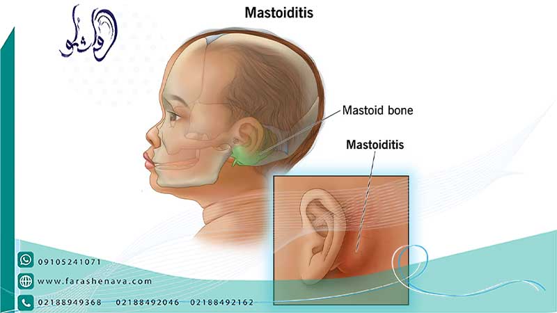 ماستوئیدیت یا عفونت استخوان گوش چه درمانی دارد؟
