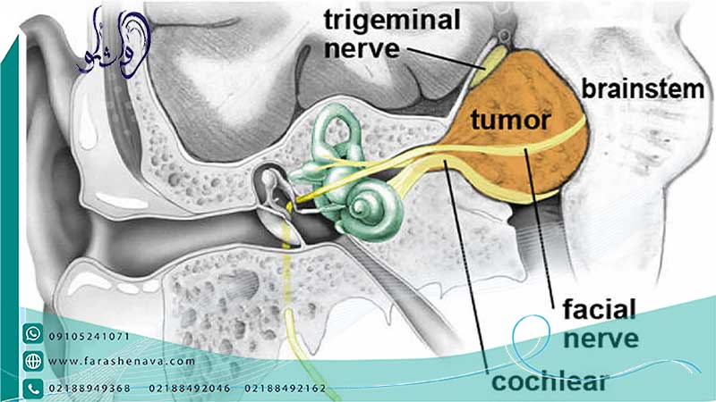 درمان تومور عصب شنوایی یا نوروم آکوستیک