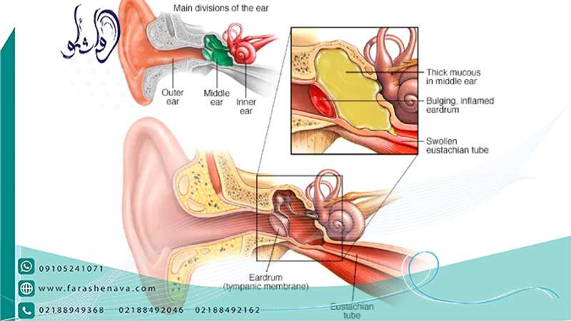 عفونت گوش میانی و درمان آنها